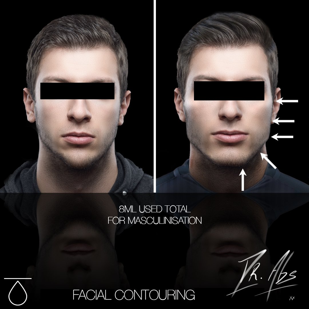 Before and after, case 1