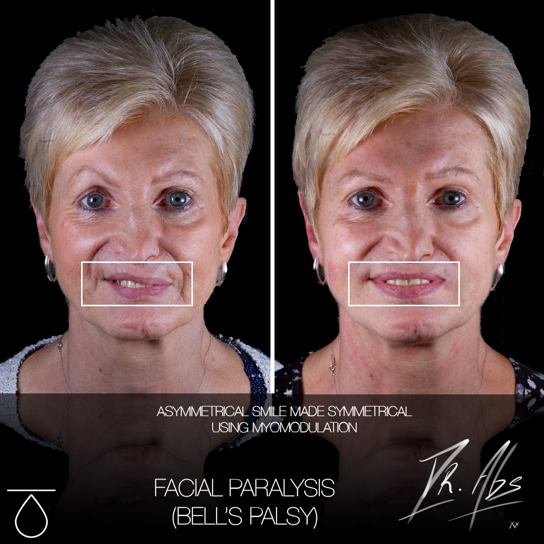 Before and after, case 2