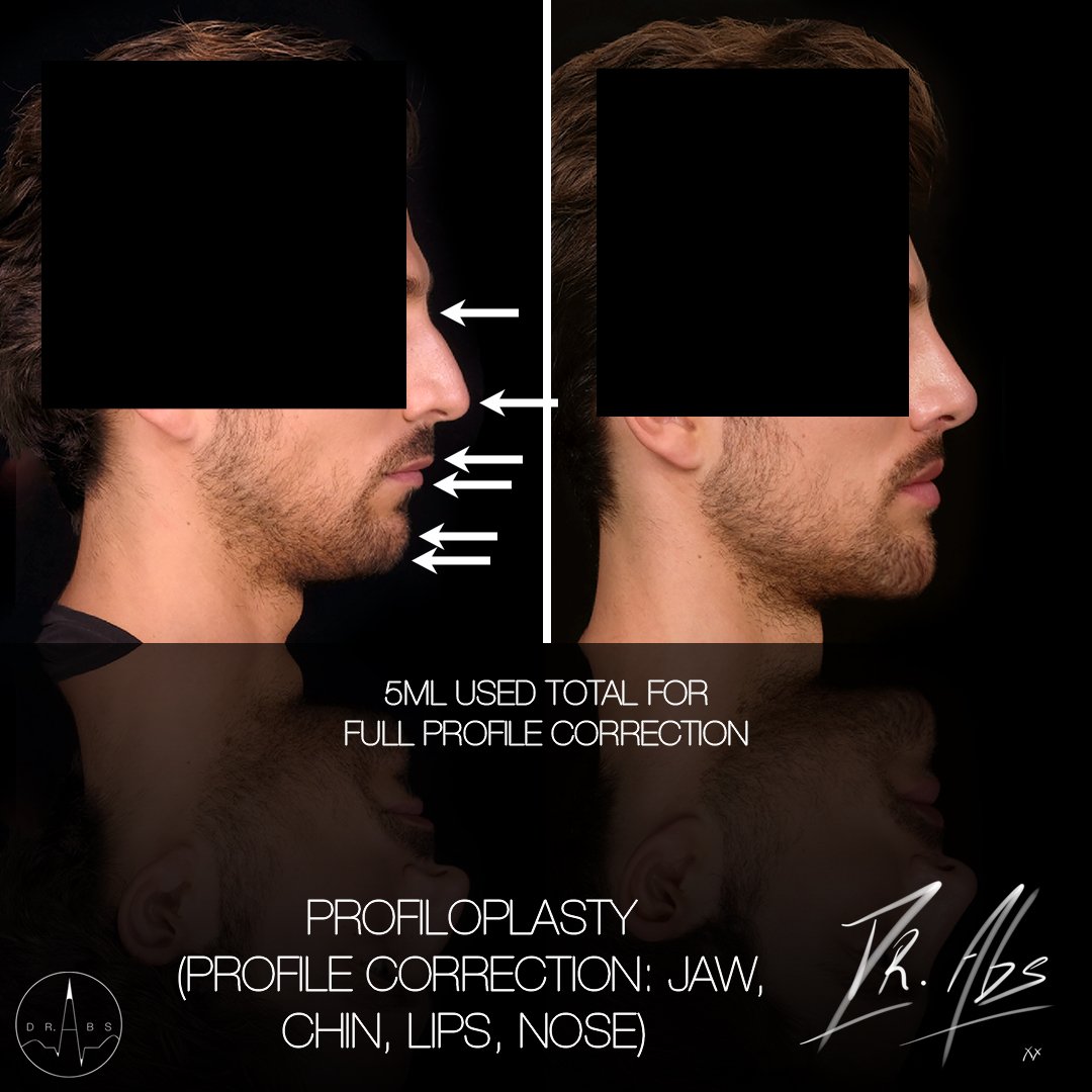 Before and after, case 4