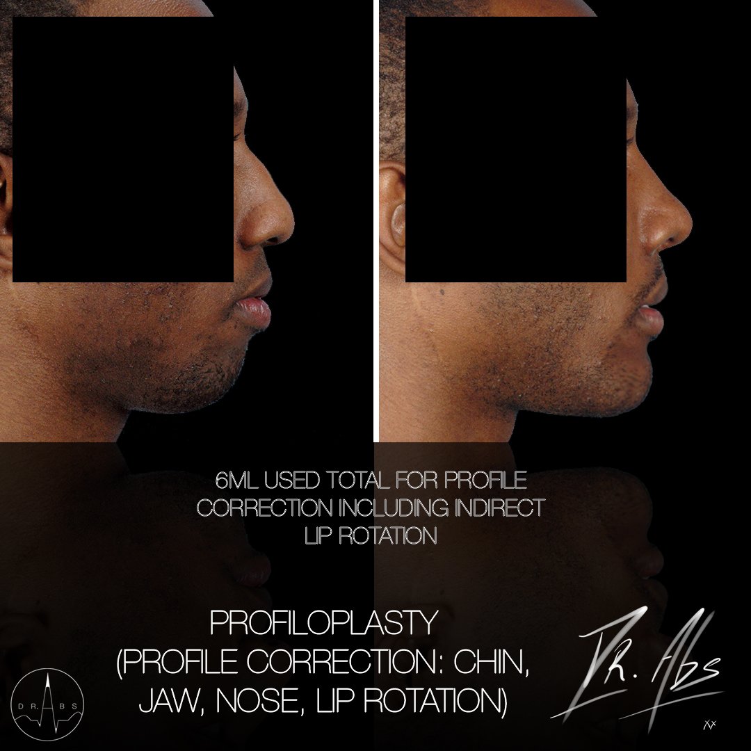 Before and after, case 5
