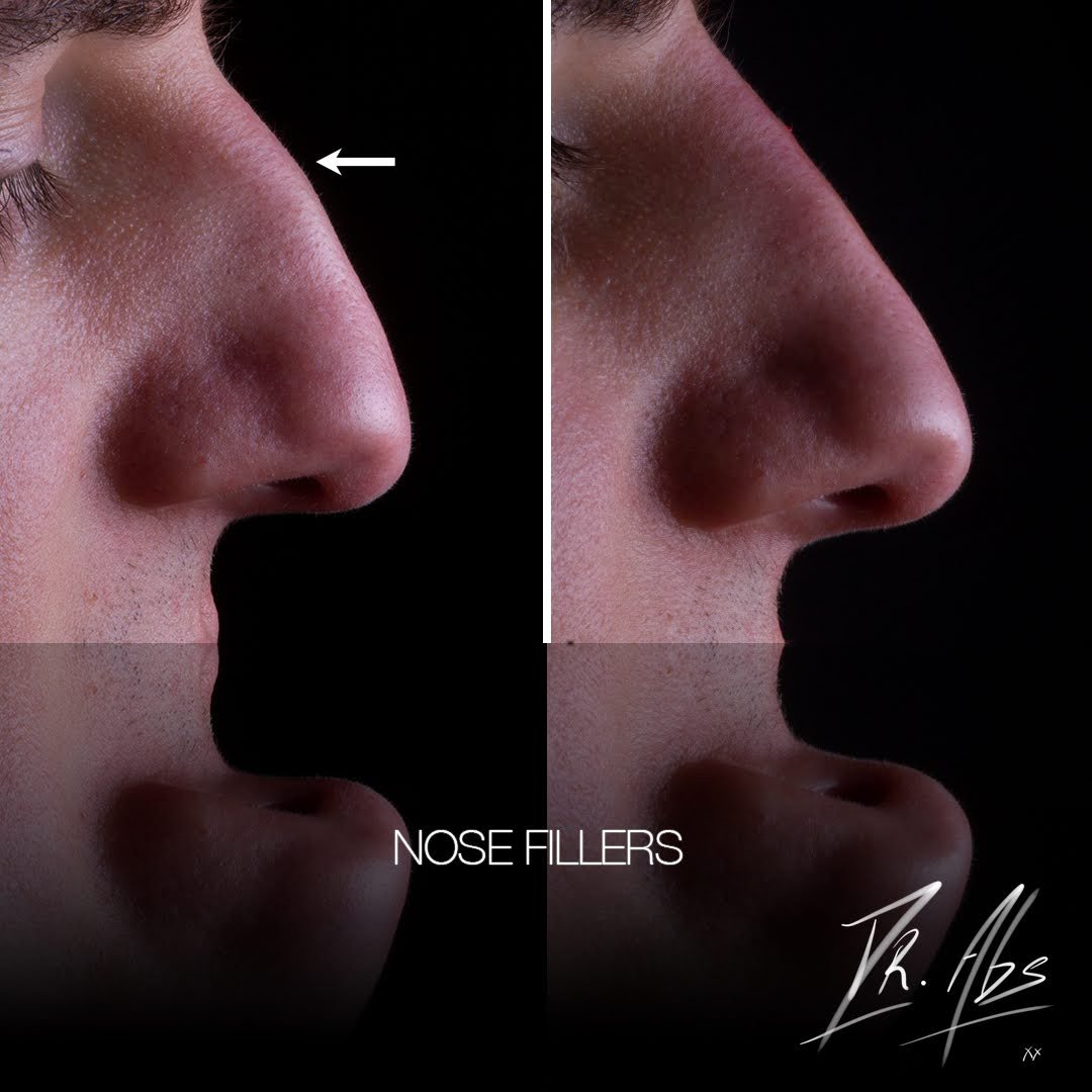 Before and after, case 11