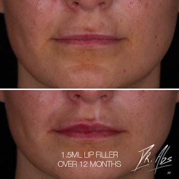 Before and after, case 15