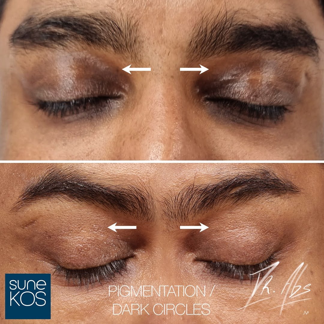 Before and after, case 20